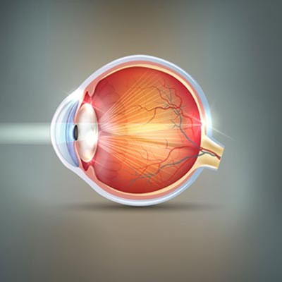 Cataracte : symptômes, traitement et diagnostic