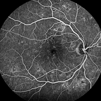 Les vasculopathies rétiniennes